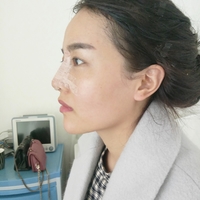 鼻头缩小对比图，真人诠释鼻头缩小后果