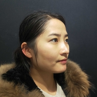 面部光纤溶脂多久起?真人日记为你解答