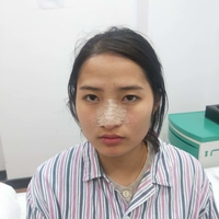 面部光纤溶脂多久起?真人日记为你解答