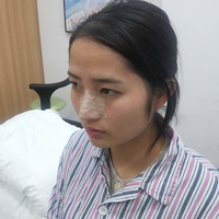面部光纤溶脂多久起?真人日记为你解答