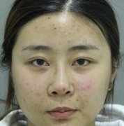 成都米兰整形医院镭射净肤35天皮肤光滑不输范冰冰 width=