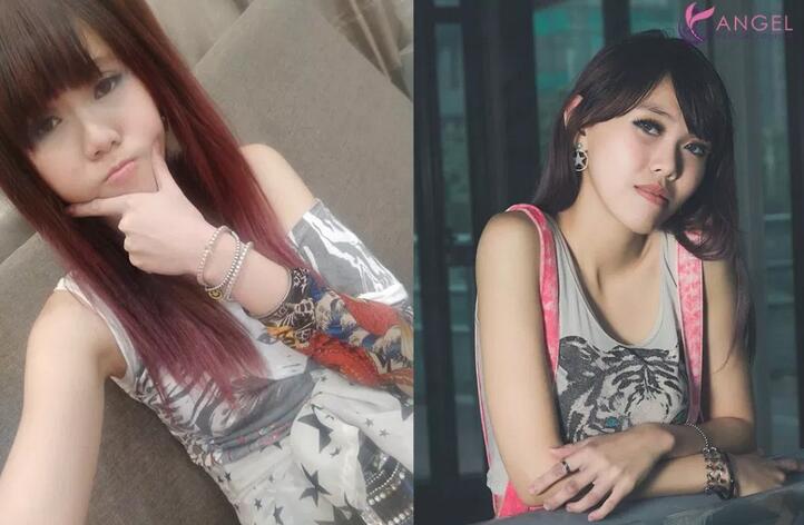 磨颧骨前后对比图