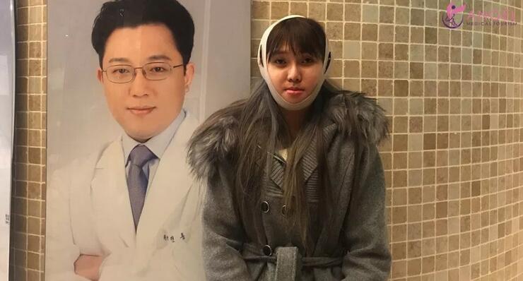 磨颧骨前后对比图
