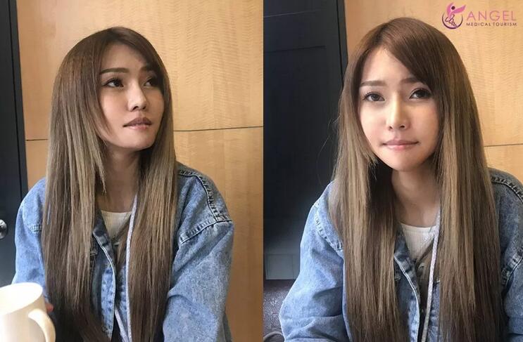 磨颧骨前后对比图