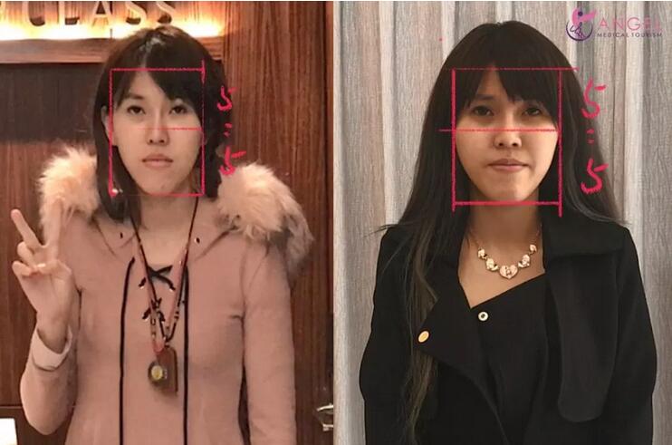 磨颧骨前后对比图