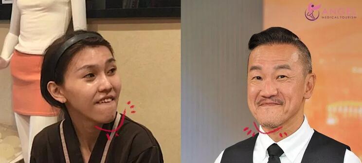 磨颧骨前后对比图