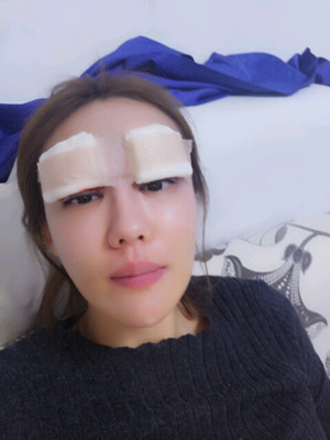 【开眼尾恢复过程图曝光，逆袭之路就此开始】
