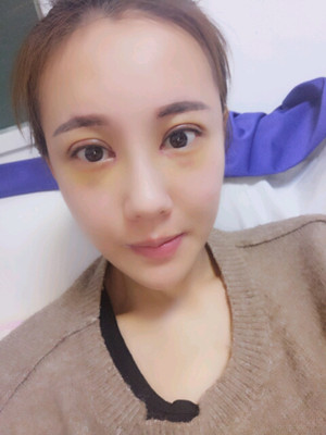 【开眼尾恢复过程图曝光，逆袭之路就此开始】