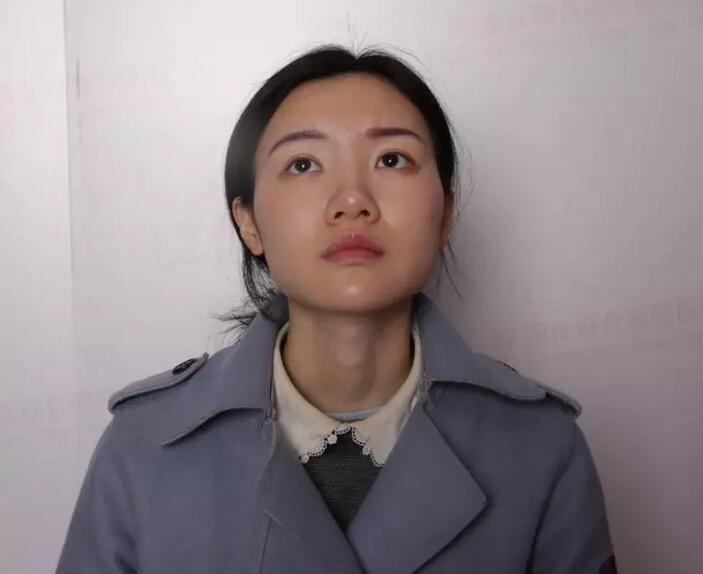 【党宁鼻翼缩小+鼻尖成形术前后对比图-见证婷婷的蜕变】