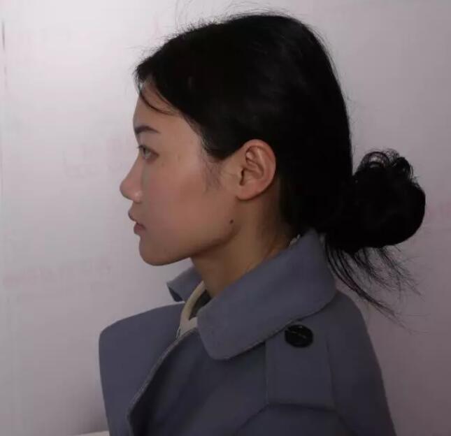 【党宁鼻翼缩小+鼻尖成形术前后对比图-见证婷婷的蜕变】