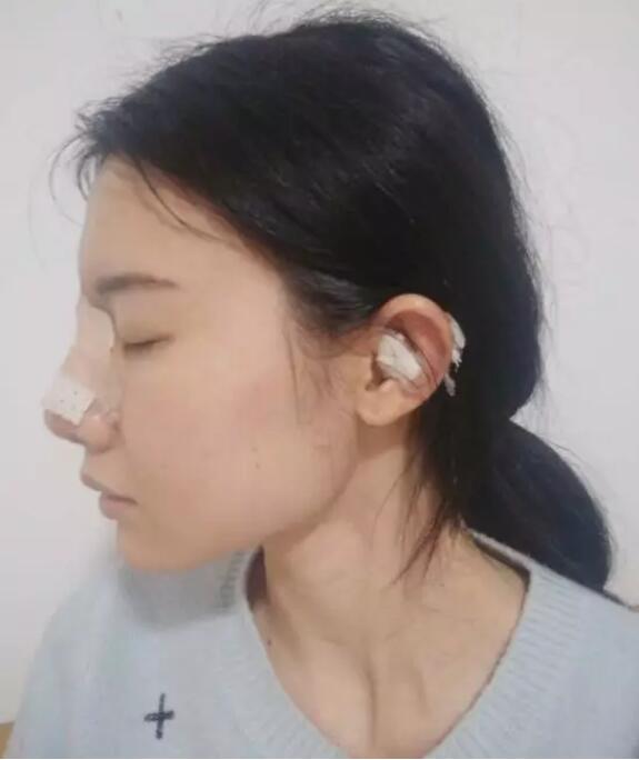 【党宁鼻翼缩小+鼻尖成形术前后对比图-见证婷婷的蜕变】