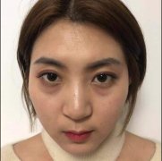 成都华博整形医院价格表 【辣妹子不开刀祛眼袋恢复分享】 width=
