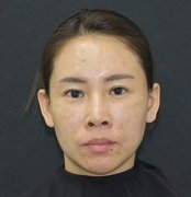 【金海兰案例】激光祛斑前后对比照片分享：30+辣妈的改变 width=