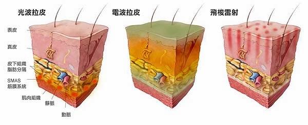 光波拉皮有什么危害?能避免吗?