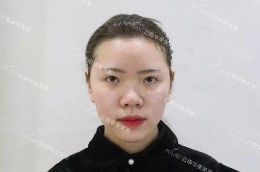 塌鼻子隆鼻前后对比