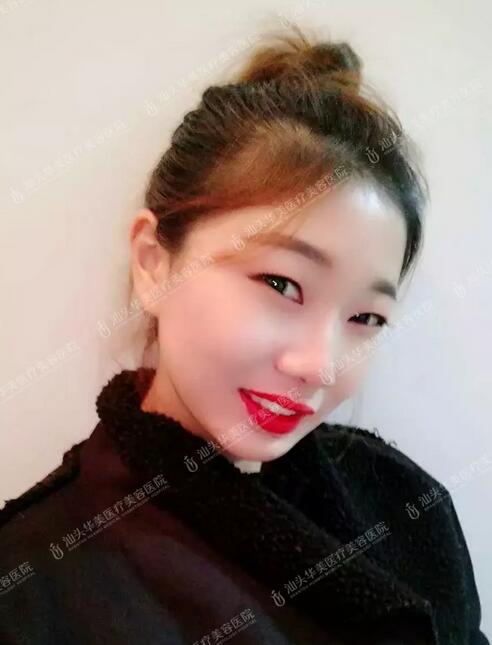 北京生物焊接双眼皮