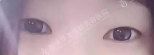 北京生物焊接双眼皮