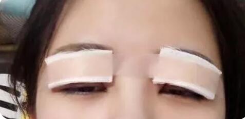 北京生物焊接双眼皮