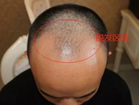 健身真的会掉头发变成光头吗？