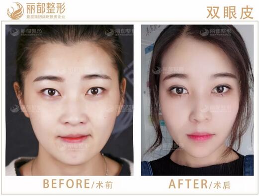 贵阳丽都整形： 这几类眼睛在做双眼皮前一定要谨慎！！！