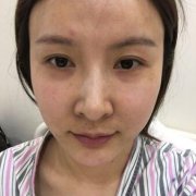 【米兰柏羽假体隆鼻1-8天的对比图】内附价目表 width=