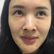 泉美整形水滴鼻45天对比|水滴鼻整形适合85%的妹纸哦~ width=