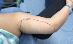 【伊美尔长岛整形蝴蝶臂吸脂案例对比】内附价目表 width=