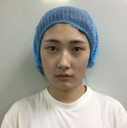 张韩献面部埋线-提升除皱案例分享：重回18岁 width=