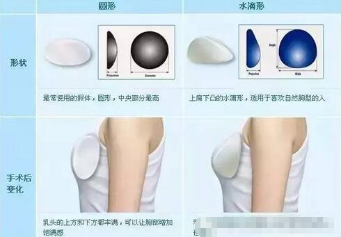 曼托妙桃假体丰胸的价格是多少?是不是有点贵哟~