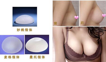 曼托妙桃假体丰胸的价格是多少?是不是有点贵哟~