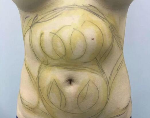 腰腹吸脂减肥手术案例分享，前后对比果图片来袭！