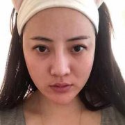 大连王艇隆鼻36天对比照——真人案例曝光一览 width=