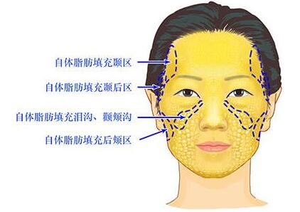 去鼻唇沟多少钱?在成都去鼻唇沟失败修复多少钱呢?