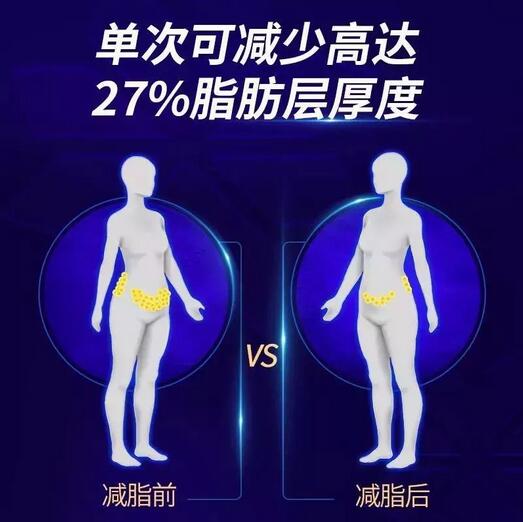 酷塑冷冻溶脂|让你躺着就能瘦下来的黑科技~