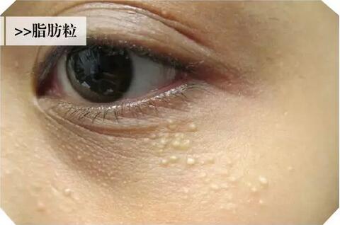 汗管瘤的调节方法有哪些安？我查到了这些资料~