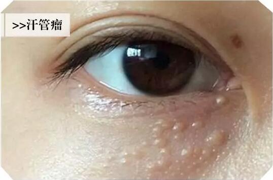 汗管瘤的调节方法有哪些安？我查到了这些资料~
