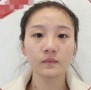【蔡仁祥案例贴】蔡仁祥双眼皮对比图，终于甩掉了厚厚的眼镜儿~ width=