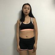 李朕国际体雕中心【360度环形吸脂107天案例分享】 width=