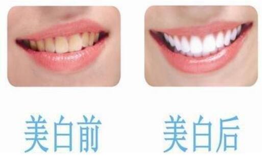 皓齿美白牙齿多少钱，到底贵不贵呢?