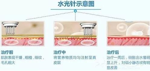 涂抹式水光补水和水光补水有什么区别?科普时间到~