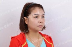肉毒毒素瘦脸真实案例分享——拒绝油腻、显老问题！ width=