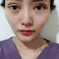 曹仁昌医生双眼皮修复真的很牛逼?真实案例走一波