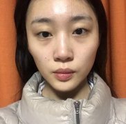 石家庄二院整形张卓男全切双眼皮案例，两个月的逆天转变~ width=