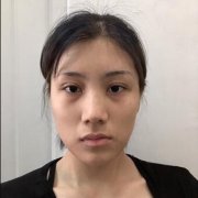 蒋亚楠塌鼻子整形案例：77天捕捉一对桃花眼 width=