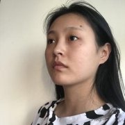 双美胶原蛋白注射隆鼻前后对比图，短短20天就变了 width=