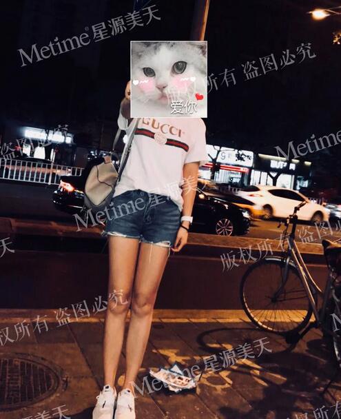 360度环形吸脂|困扰了我多年的大象腿，终于不见了！