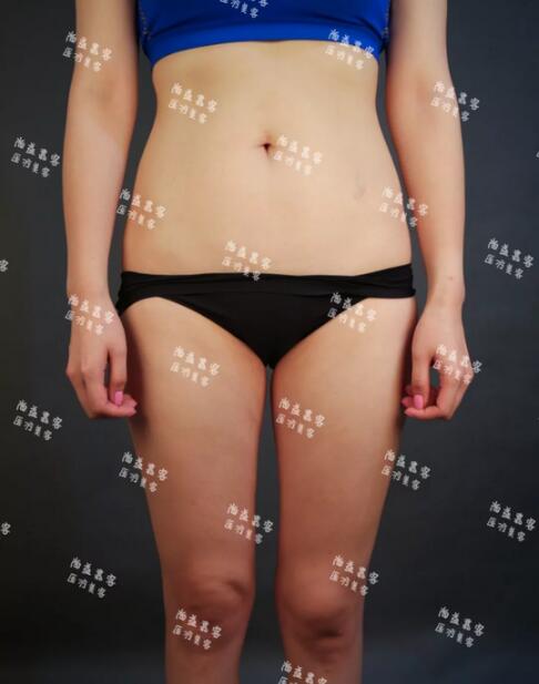大腿内侧吸脂+腰腹吸脂减肥+自体脂肪丰臀真人案例，来看看？