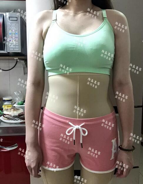 大腿内侧吸脂+腰腹吸脂减肥+自体脂肪丰臀