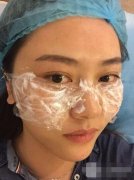吕成志激光祛斑亲身体验经验总结：132天能有什么变化~ width=