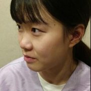 庄洪兴韩式生科隆鼻案例：34天肉眼的速度见证恢复果 width=